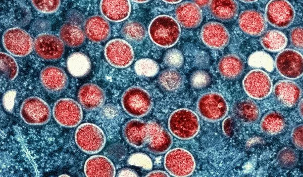 Monkeypox viruses relatively stable on surfaces
