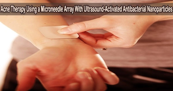 Acne Therapy Using a Microneedle Array With Ultrasound-Activated Antibacterial Nanoparticles
