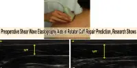 Preoperative Shear Wave Elastography Aids in Rotator Cuff Repair Prediction, Research Shows