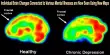 Individual Brain Changes Connected to Various Mental Illnesses are Now Seen Using New Maps