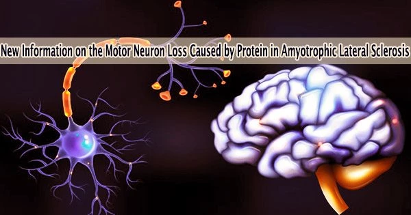 New Information on the Motor Neuron Loss Caused by Protein in Amyotrophic Lateral Sclerosis