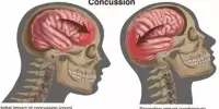 Reducing Post-concussion Injuries