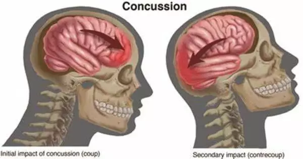 Reducing Post-concussion Injuries