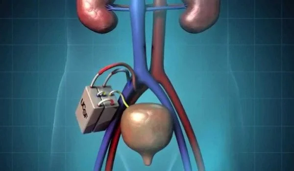 Can an artificial kidney finally free patients from dialysis?