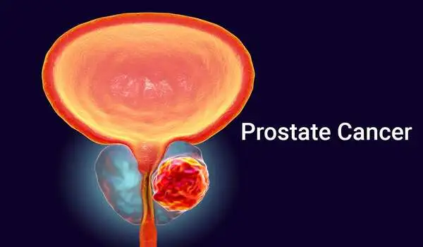 Research into use of diabetes medication for treatment of metastatic prostate cancer