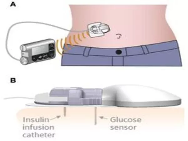 An implantable device could enable injection-free control of diabetes