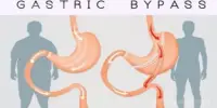 Gastric Bypass has Short-lived Positive Metabolic Effects