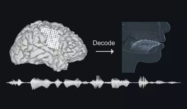 Brain signals transformed into speech through implants and AI