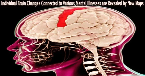 Individual Brain Changes Connected to Various Mental Illnesses are Revealed by New Maps