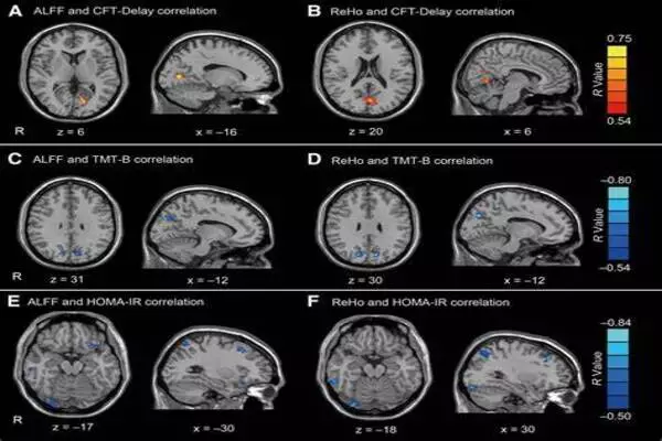 Diabetes linked to functional and structural brain changes through MRI