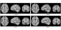 MRI has connected Diabetes to Functional and structural Brain Alterations
