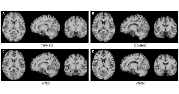 MRI has connected Diabetes to Functional and structural Brain Alterations