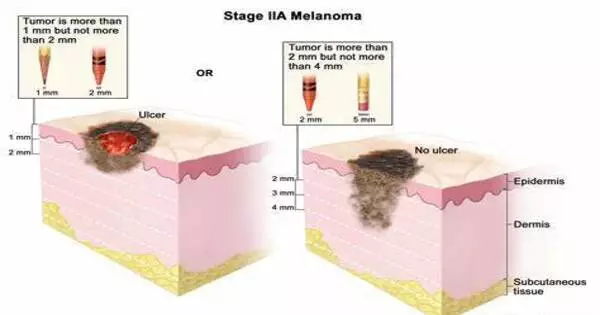 New Insights Regarding the Development and Treatment of Melanoma