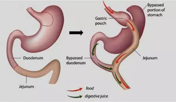 The-Positive-Metabolic-Advantages-of-Gastric-Bypass-Fade-Fast-1