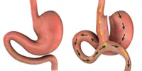 The Positive Metabolic Advantages of Gastric Bypass Fade Fast