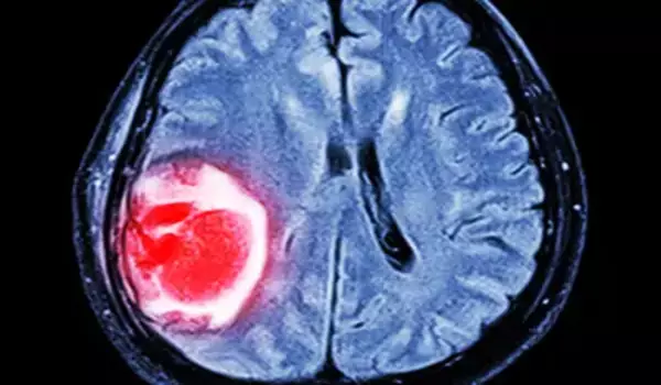 AI speeds up identification brain tumor type