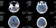 AI Accelerates the Detection of Brain Tumor Types