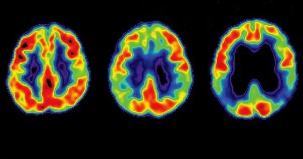 Alzheimer’s Disease is Slowed by Specialized T Cells in the Brain