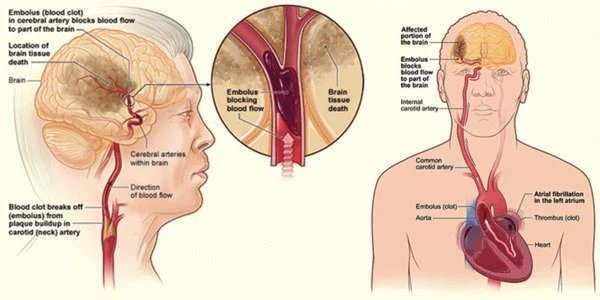 Atrial fibrillation and stroke risk