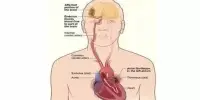 Atrial Fibrillation and the Risk of Stroke