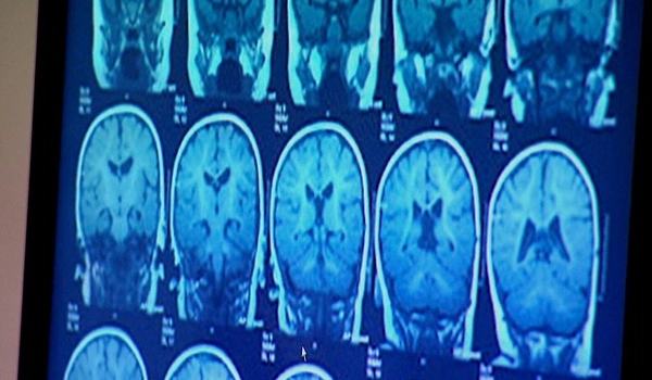 Brain biometrics help identify sports concussions