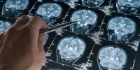 For up to an Hour following Treatment, Targeted Ultrasound can alter Brain Activity