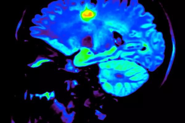 Brain connectivity is disrupted in schizophrenia