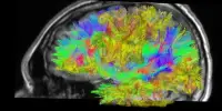 In Schizophrenia, Brain Connection is Disturbed