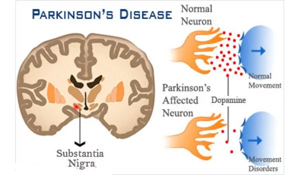Compensation by healthy brain parts alleviates Parkinson symptoms