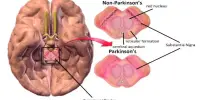 Parkinson Symptoms are reduced by Compensating with Healthy Brain Areas