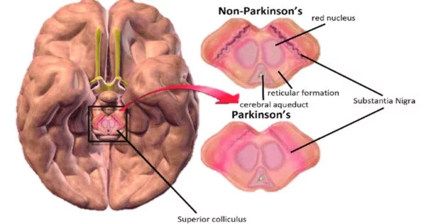 Parkinson Symptoms are reduced by Compensating with Healthy Brain Areas