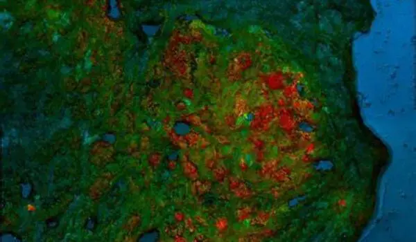 Researchers develop innovative technique for distinguishing tumor from normal tissue