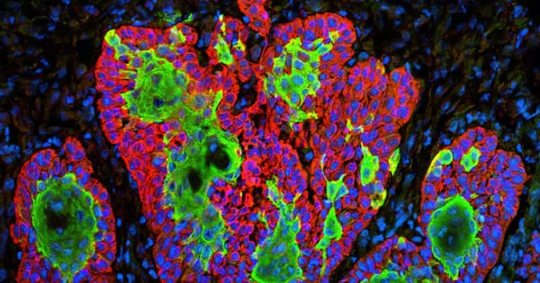 Researchers Devise a Novel method for identifying Tumors from Normal Tissue