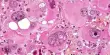 Pleomorphism – a term used in histology and cytopathology