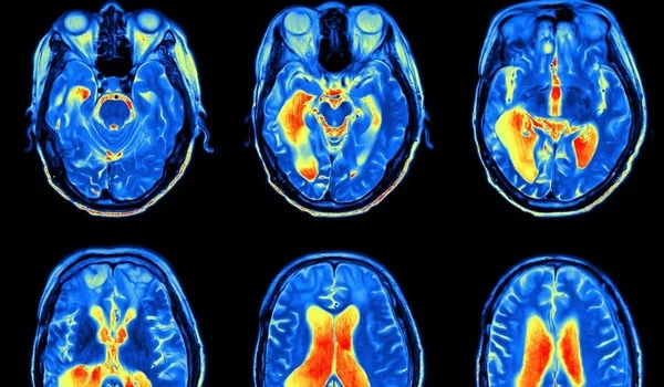 Brain imaging identifies biomarkers of mental illness