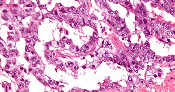 Germ Cell Tumor (GCT)