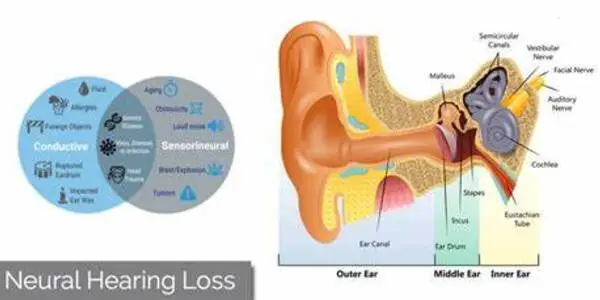 Hearing loss is associated with subtle changes in the brain