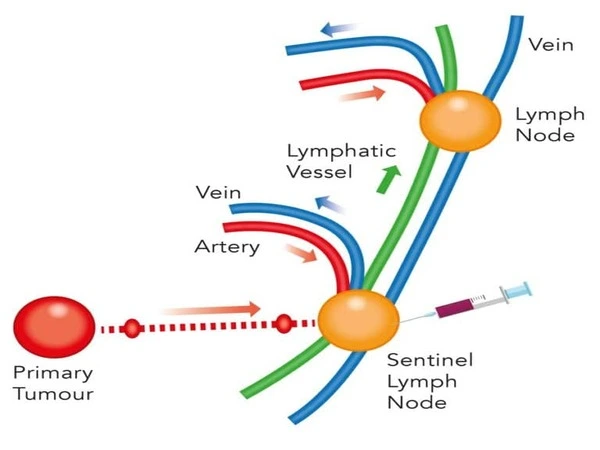 Novel approach for lymph node metastasis treatment