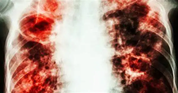 Adapting the Immune System to Combat Tuberculosis