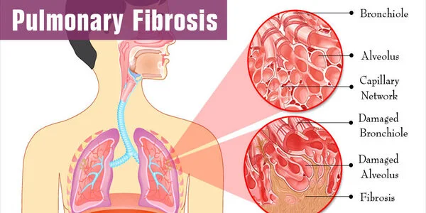 Bacteria in the mouth linked to pulmonary fibrosis survival