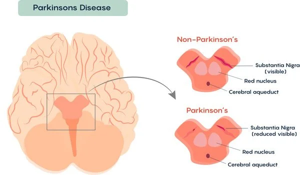 Using magnetized neurons to treat Parkinson's disease symptoms