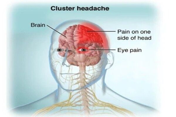 Are people with cluster headaches more likely to have other illnesses?