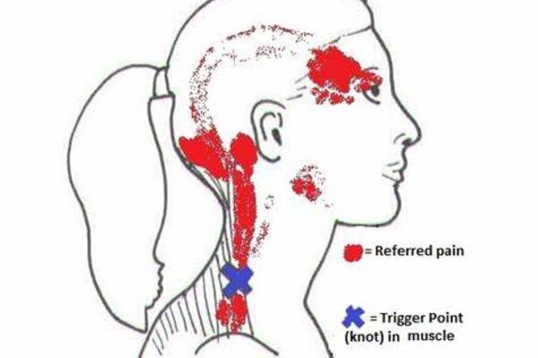 Common headaches tied to neck inflammation