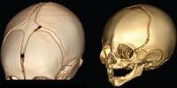 Identified a Genetic Variation that Molded the Human Skull Base