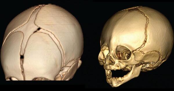 Identified a Genetic Variation that Molded the Human Skull Base