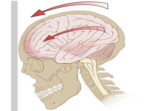 Reducing subsequent injuries after a concussion