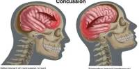 Reducing Secondary Injuries Following a Concussion