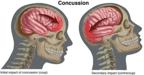 Reducing Secondary Injuries Following a Concussion