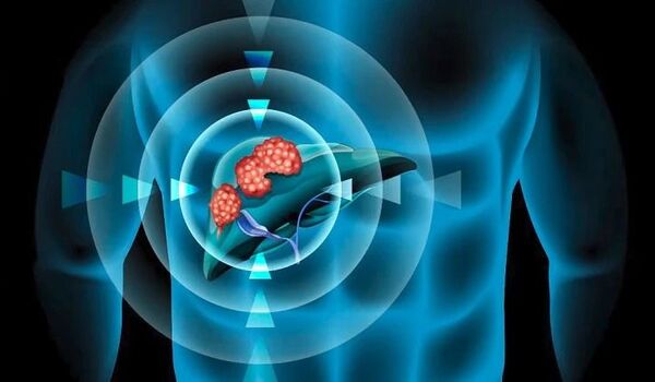 Treating liver cancer with microrobots piloted by a magnetic field