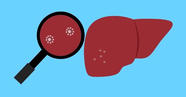 Using a Magnetic Field to Guide Microrobots in Treating Liver Cancer